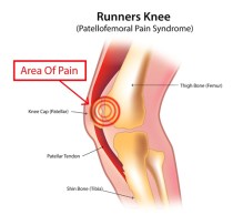 runners-knee-patellofemoral-pain-syndrome